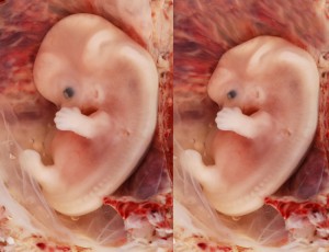 À gauche: foetus normal. À droite: fœtus totalement crétin après 2h de TPMP.