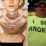 anorexic